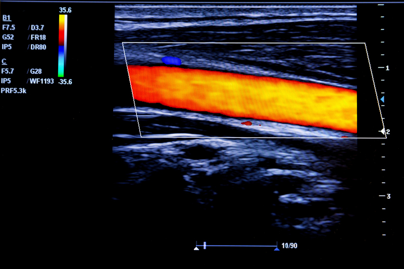 Vascular Ultrasound Imaging